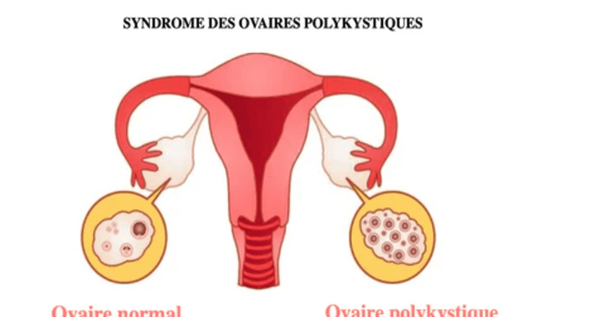 SOPK : 5 Points Essentiels à Connaître sur le Syndrome des Ovaires Polykystiques