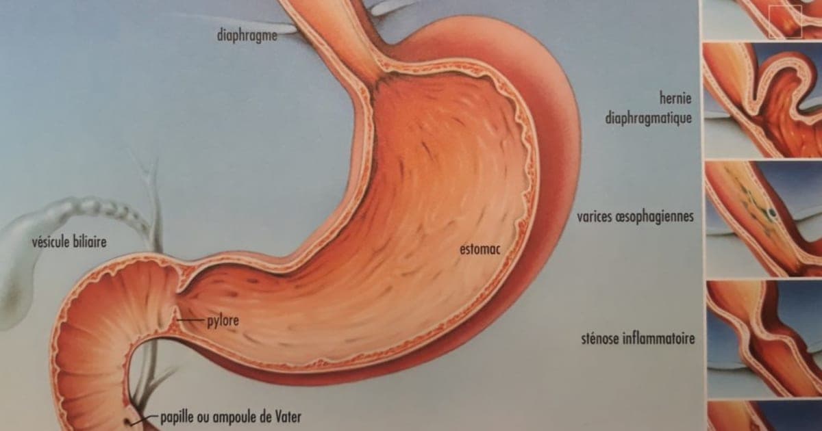 Reflux gastro-œsophagien : comment l'alimentation peut soulager les brûlures d'estomac et les régurgitations